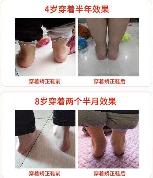 怎样纠正宝宝的内八字脚(宝宝走路八字脚)